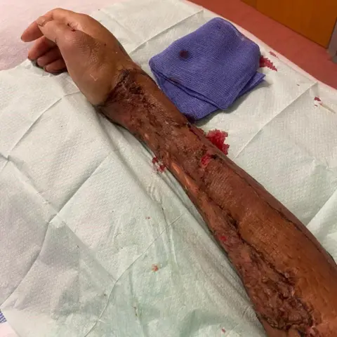 Charlene Morrisey An image showing the arm as it begins to heal