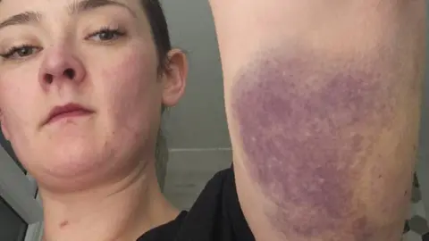 Claire Miller Claire Miller holding her arm up to show a large bruise on her tricep area. Her face is in shot, and she has dark hair/ Behind her are white coloured walls.