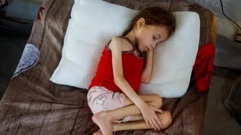 Reuters Jana Ayad, a Palestinian girl wears a red vest and pink shorts, her thin arms and legs folded on a bed. She is malnourished, according to medics at the International Medical Corps field hospital, amid the Israel-Hamas conflict, in Deir Al-Balah, southern Gaza strip.