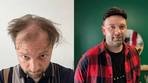Luke Shepherd / BBC On the left is a man with his head tilted slightly forward to reveal his hair loss. His remaining hair is dark brown. He has some stubble and is wearing a navy top with beige stripes. On the right is the same man with his black hair system fitted. He's looking at the camera and he's wearing a red and black chequered shirt over a black tshirt.