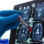 Alzheimer’s blood test could ‘revolutionise’ diagnosis
